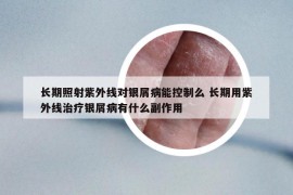 長(zhǎng)期照射紫外線對(duì)銀屑病能控制么 長(zhǎng)期用紫外線治療銀屑病有什么副作用