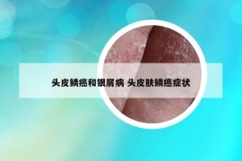 頭皮鱗癌和銀屑病 頭皮膚鱗癌癥狀