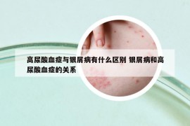 高尿酸血癥與銀屑病有什么區(qū)別 銀屑病和高尿酸血癥的關(guān)系