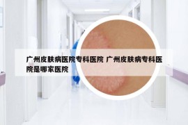 廣州皮膚病醫(yī)院專(zhuān)科醫(yī)院 廣州皮膚病專(zhuān)科醫(yī)院是哪家醫(yī)院