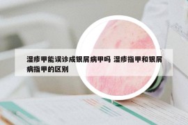 濕疹甲能誤診成銀屑病甲嗎 濕疹指甲和銀屑病指甲的區(qū)別