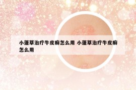 小蓬草治療牛皮癬怎么用 小蓬草治療牛皮癬怎么用