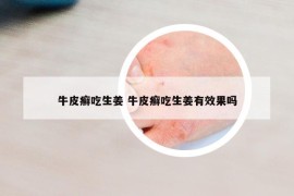 牛皮癬吃生姜 牛皮癬吃生姜有效果嗎