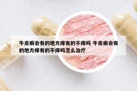 牛皮癬會(huì)有的地方癢有的不癢嗎 牛皮癬會(huì)有的地方癢有的不癢嗎怎么治療