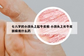七八歲的小孩頭上起牛皮癬 小孩頭上長牛皮膚癬用什么藥