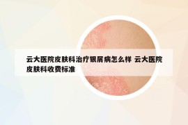 云大醫(yī)院皮膚科治療銀屑病怎么樣 云大醫(yī)院皮膚科收費標(biāo)準(zhǔn)
