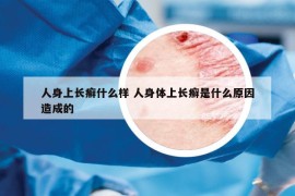 人身上長(zhǎng)癬什么樣 人身體上長(zhǎng)癬是什么原因造成的