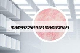銀屑病可以吃新鮮白蒿嗎 銀屑病能吃白蒿嗎