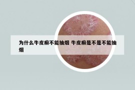 為什么牛皮癬不能抽煙 牛皮癬是不是不能抽煙