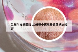 蘭州牛皮癬醫(yī)院 蘭州哪個醫(yī)院看銀屑病比較好