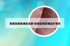 膿皰型銀屑病皮友群 膿皰型銀屑病治療用藥