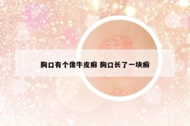 胸口有個(gè)像牛皮癬 胸口長(zhǎng)了一塊癬
