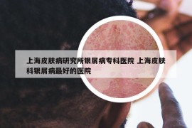 上海皮膚病研究所銀屑病?？漆t(yī)院 上海皮膚科銀屑病最好的醫(yī)院