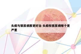 頭癬與銀屑病那更好治 頭癬和銀屑病哪個(gè)更嚴(yán)重