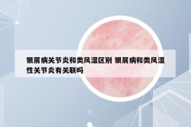 銀屑病關(guān)節(jié)炎和類風濕區(qū)別 銀屑病和類風濕性關(guān)節(jié)炎有關(guān)聯(lián)嗎