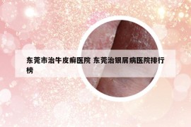 東莞市治牛皮癬醫(yī)院 東莞治銀屑病醫(yī)院排行榜