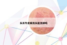 頭長(zhǎng)牛皮癬洗頭能洗掉嗎