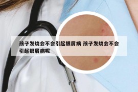 孩子發(fā)燒會不會引起銀屑病 孩子發(fā)燒會不會引起銀屑病呢