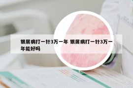 銀屑病打一針3萬一年 銀屑病打一針3萬一年能好嗎