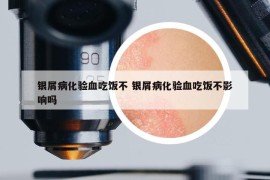 銀屑病化驗血吃飯不 銀屑病化驗血吃飯不影響嗎