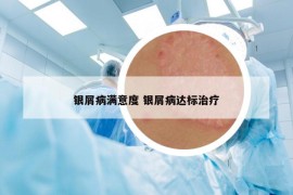 銀屑病滿意度 銀屑病達(dá)標(biāo)治療
