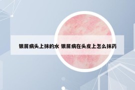 銀屑病頭上抹的水 銀屑病在頭皮上怎么抹藥