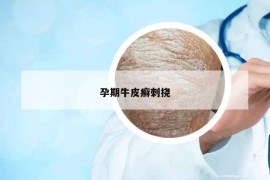 孕期牛皮癬刺撓