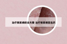 治療銀屑病綜合方要 治療銀屑病首選藥