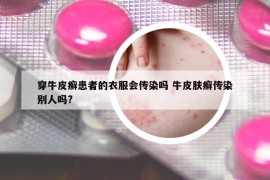 穿牛皮癬患者的衣服會傳染嗎 牛皮膚癬傳染別人嗎?