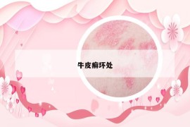 牛皮癬壞處
