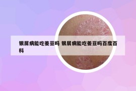 銀屑病能吃姜豆嗎 銀屑病能吃姜豆嗎百度百科