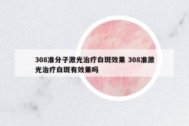308準(zhǔn)分子激光治療白斑效果 308準(zhǔn)激光治療白斑有效果嗎