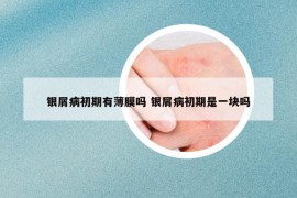 銀屑病初期有薄膜嗎 銀屑病初期是一塊嗎