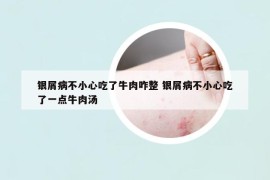 銀屑病不小心吃了牛肉咋整 銀屑病不小心吃了一點(diǎn)牛肉湯
