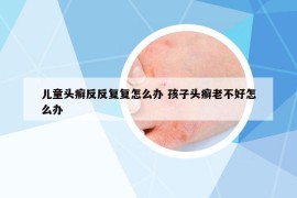 兒童頭癬反反復(fù)復(fù)怎么辦 孩子頭癬老不好怎么辦