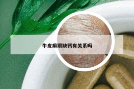 牛皮癬跟缺鈣有關(guān)系嗎