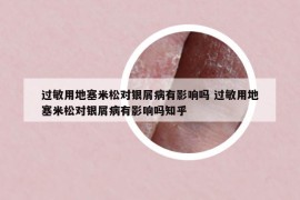 過(guò)敏用地塞米松對(duì)銀屑病有影響嗎 過(guò)敏用地塞米松對(duì)銀屑病有影響嗎知乎