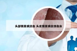 頭部銀屑病涼血 頭皮銀屑病會滲血水