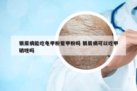 銀屑病能吃龜甲粉鱉甲粉嗎 銀屑病可以吃甲硝唑嗎