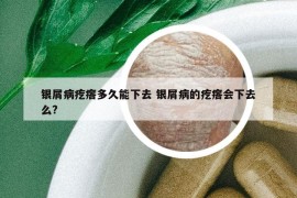 銀屑病疙瘩多久能下去 銀屑病的疙瘩會(huì)下去么?