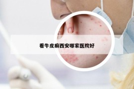 看牛皮癬西安哪家醫(yī)院好