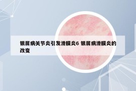 銀屑病關(guān)節(jié)炎引發(fā)滑膜炎6 銀屑病滑膜炎的改變