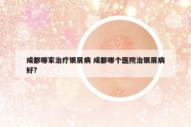 成都哪家治療銀屑病 成都哪個(gè)醫(yī)院治銀屑病好?