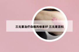 三元里治療白癜風(fēng)哪里好 三元里百科