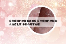 白點癲風(fēng)的早期怎么治療 白點癲風(fēng)的早期怎么治療北京 中科@專家介紹