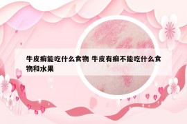 牛皮癬能吃什么食物 牛皮有癬不能吃什么食物和水果
