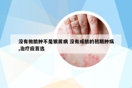 沒有微膿腫不是銀屑病 沒有成膿的初期腫瘍,治療應(yīng)首選