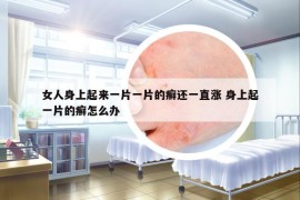 女人身上起來(lái)一片一片的癬還一直漲 身上起一片的癬怎么辦