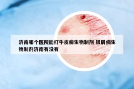濟南哪個醫(yī)院能打牛皮癬生物制劑 銀屑病生物制劑濟南有沒有