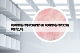 硫磺香皂對牛皮癬的作用 硫磺香皂對皮膚病有好處嗎